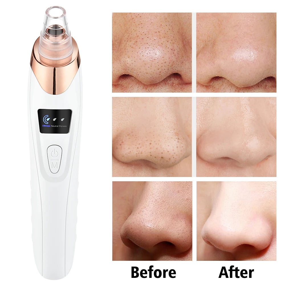 Limpiador de poros facial: removedor eléctrico de puntos negros y aspirador de acné