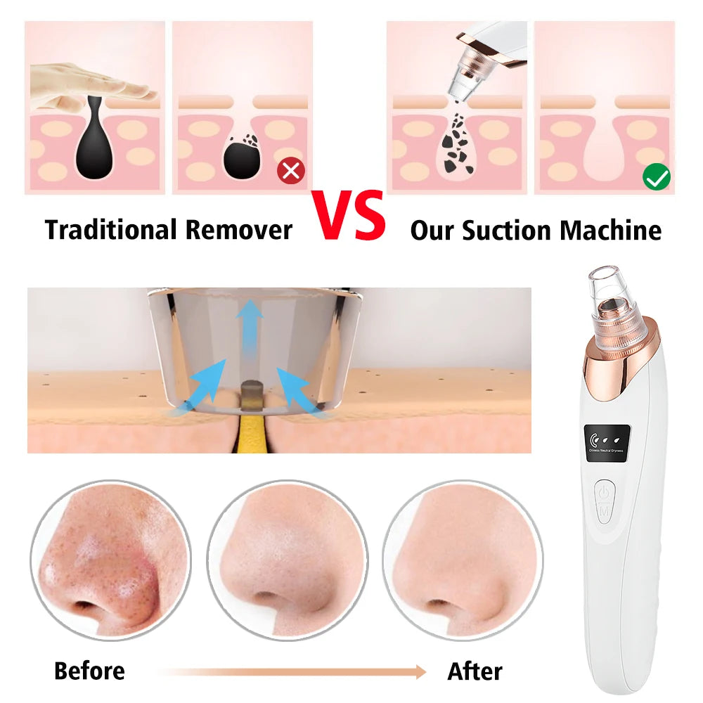 Limpiador de poros facial: removedor eléctrico de puntos negros y aspirador de acné