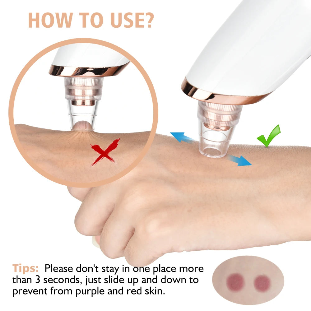 Limpiador de poros facial: removedor eléctrico de puntos negros y aspirador de acné